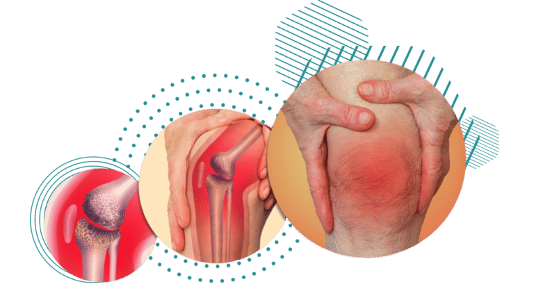 Rheumatoid Arthritis