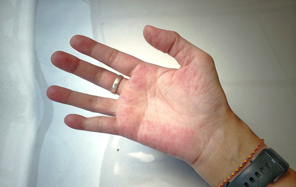 Signs symptoms of systemic lupus