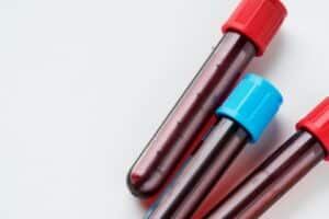 Milford Polymyalgia Rheumatica Blood Test