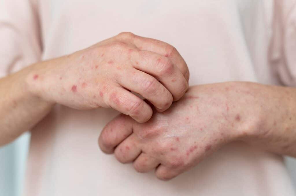 systemic lupus2