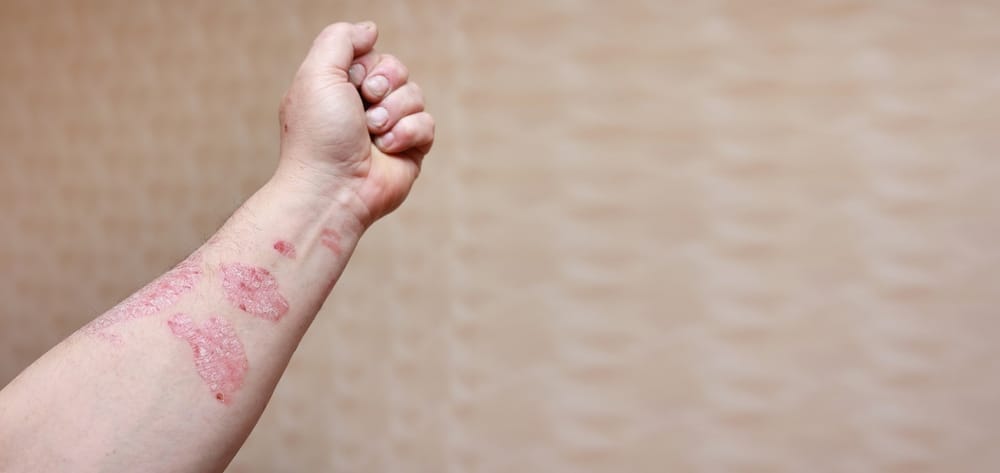 Psoriatic Arthritis Foot Pain Specialist in Milford DE