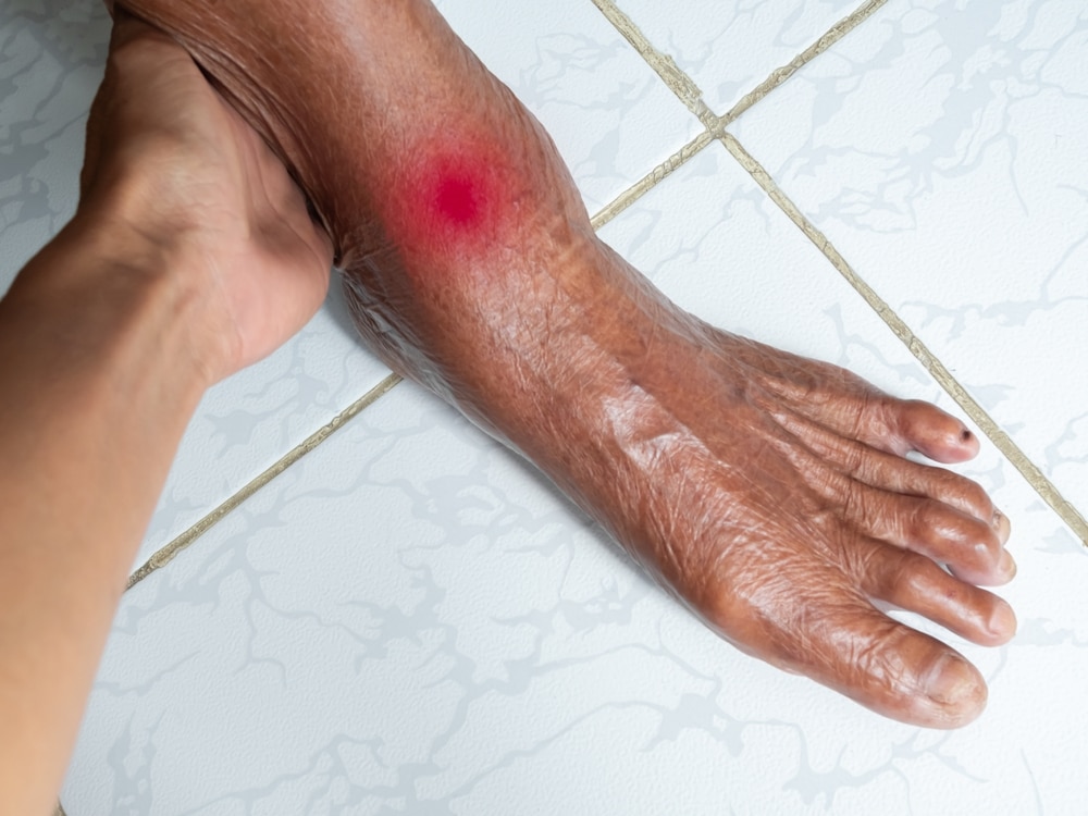 gout treatment near veterans circle milford de
